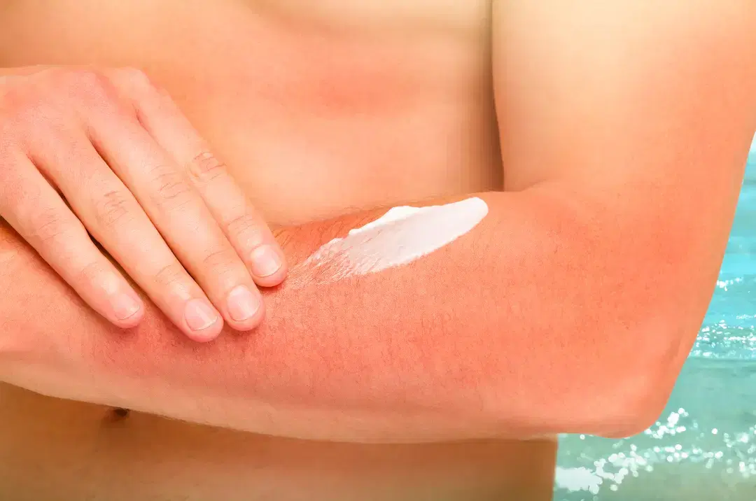 Ingrown hair prevention routine products for post-epilation aftercare