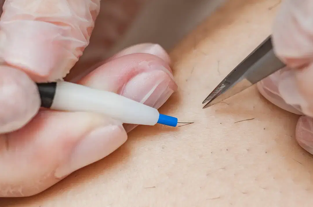 Threading hair removal method showing precise strand-by-strand removal